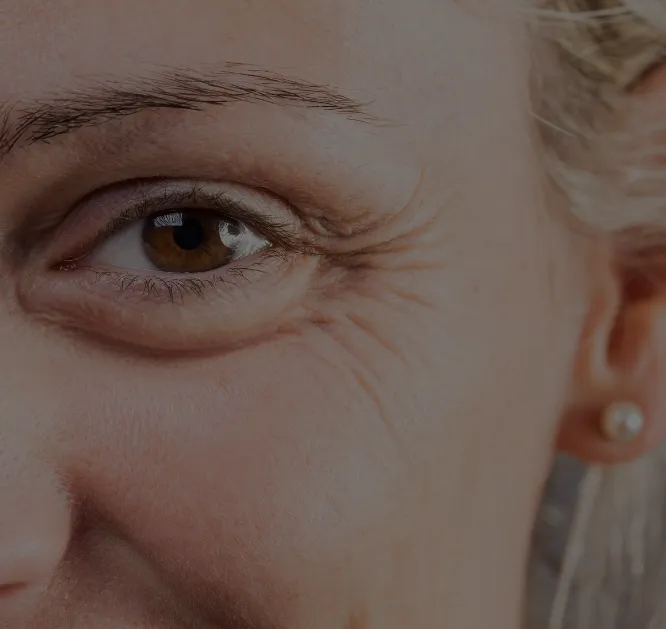 crow feet botox pic_1