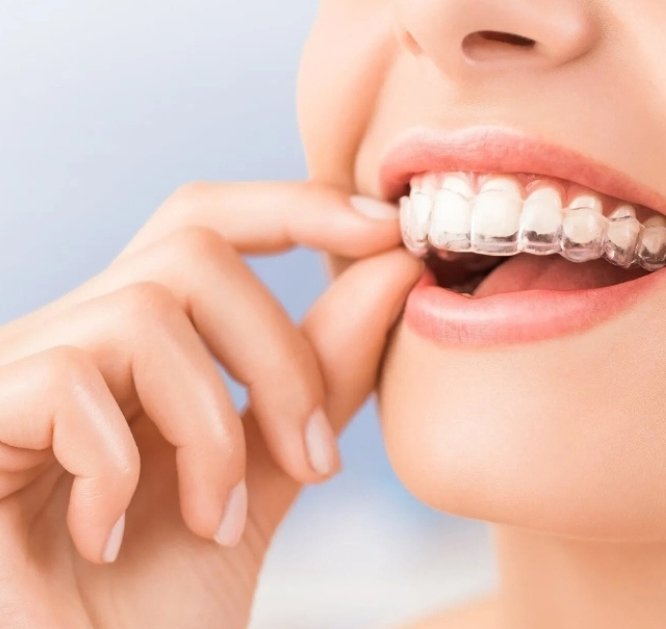 Clear Aligners_Pics (3)