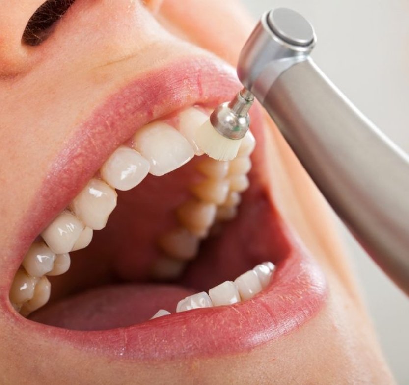 Fluoride Therapy_Pic (2)