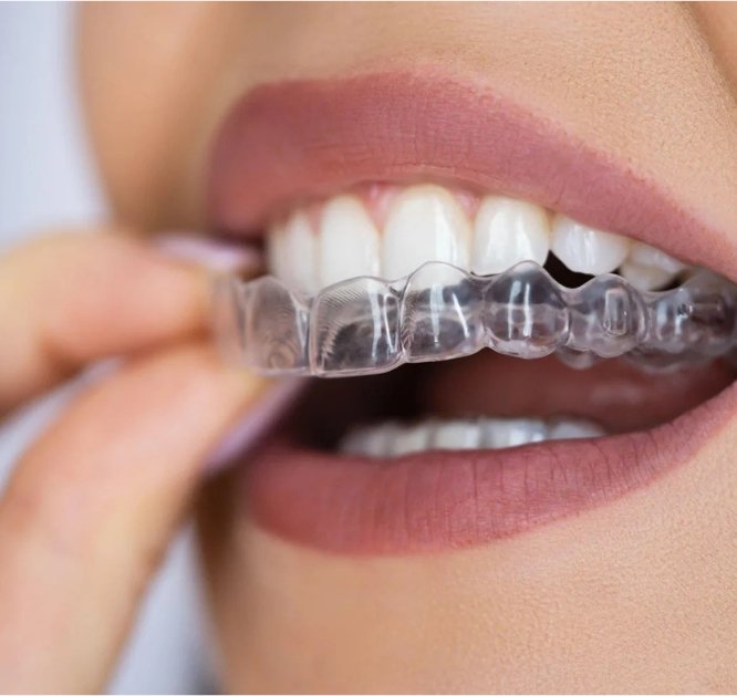 Invisalign_pic (3)
