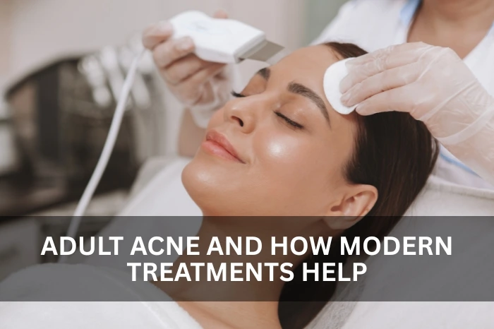 Acne Treatment in Al Nahda Dubai