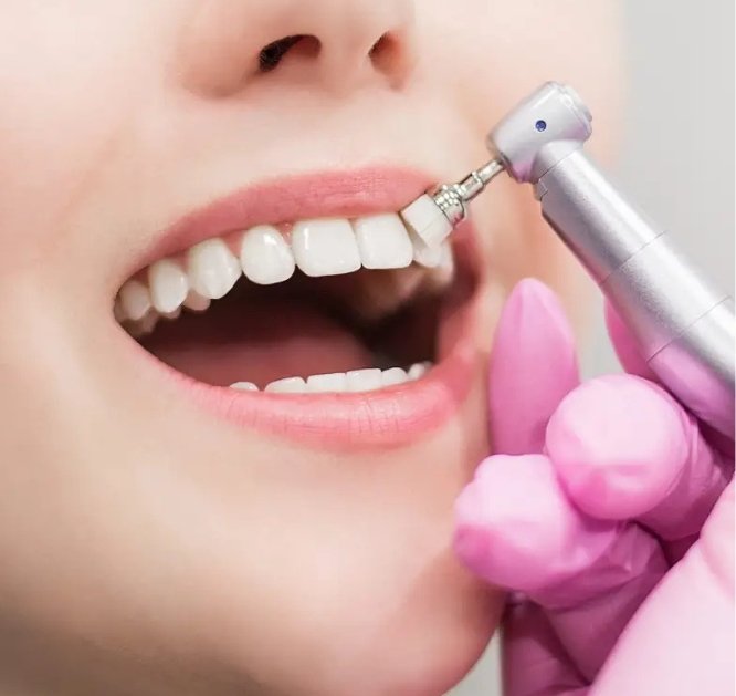 Scaling & Polishing_Img