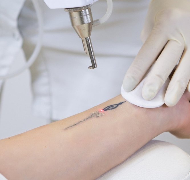 Tattoo Erase Pro pic (1)