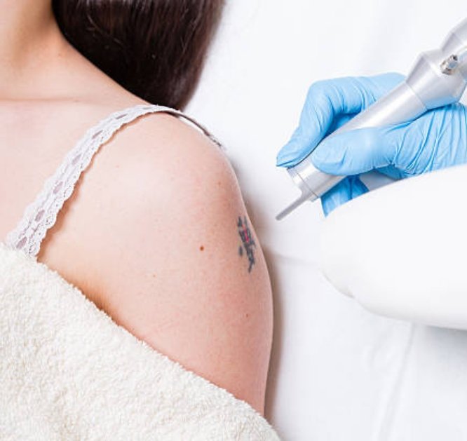 Tattoo Erase Pro pic (2)