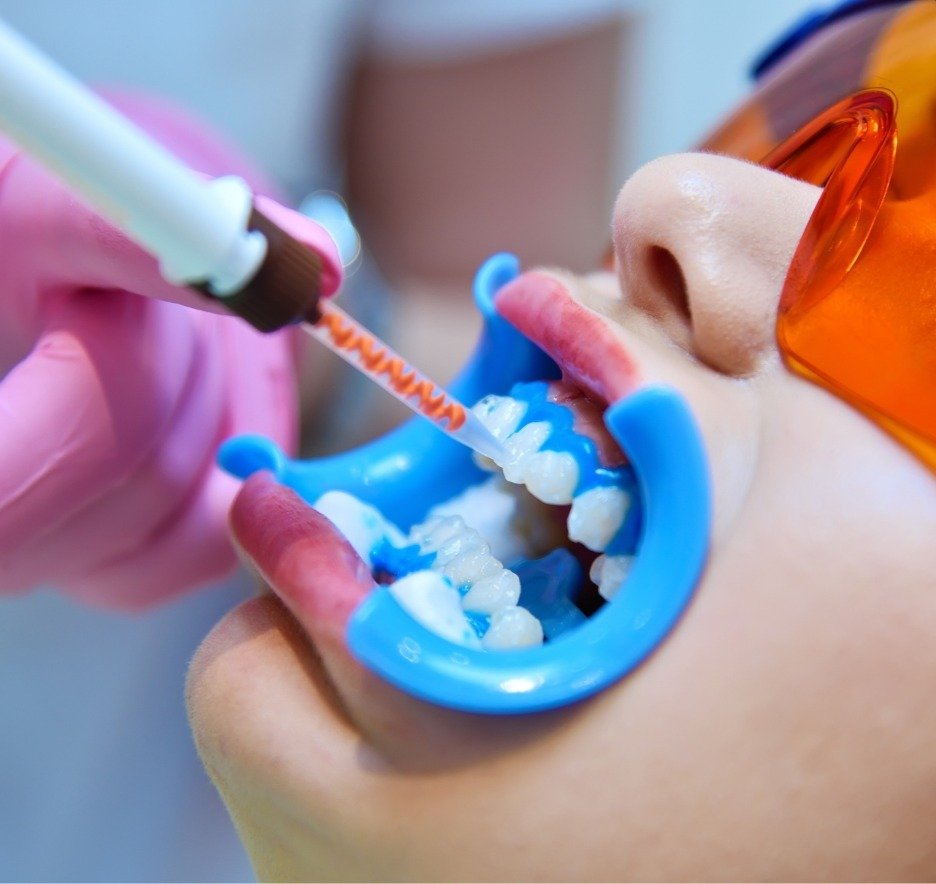 Teeth Whitening_Pic (1)