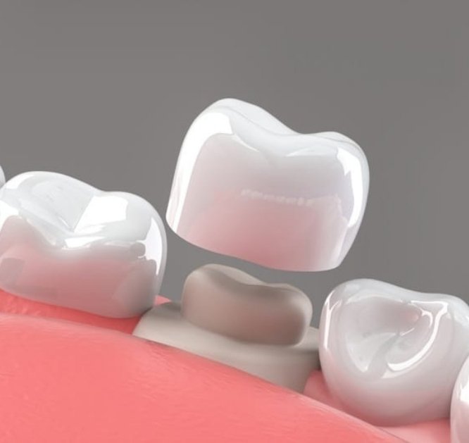 Veneers,crown & bridges_pic (2)