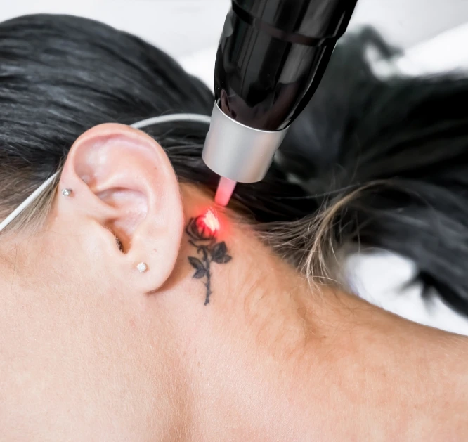 Q-switch laser tattoo removal Al Nahda
