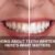 teeth whitening in dubai
